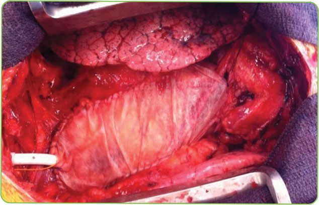 REGO-PERICARDIAL-REPAIR-2-HR Vascularized native pericardium shown in the remodeled tissue